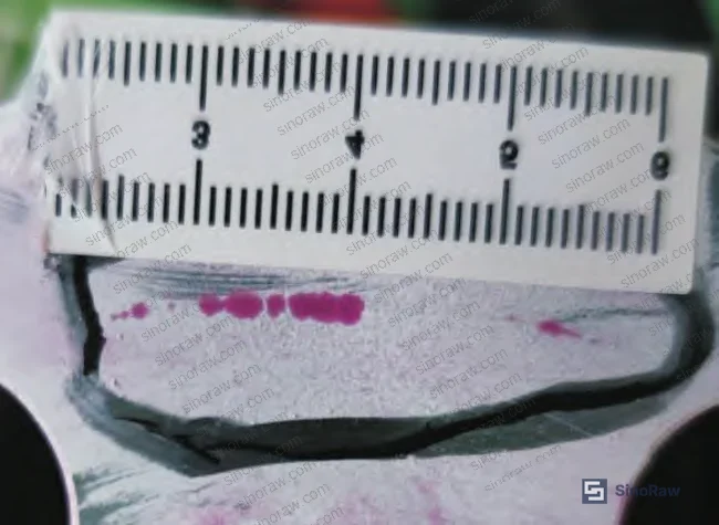 Figure 5: Close-up of flange face machining marks and penetrant indication locations — machining tool paths visible, cracks confirmed as subsurface structural defects